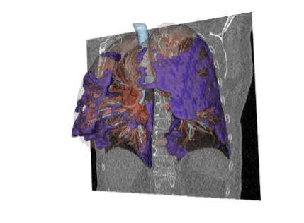 Qureight’s synthetic study arms validate clinical efficacy in pioneering rare lung disease treatment