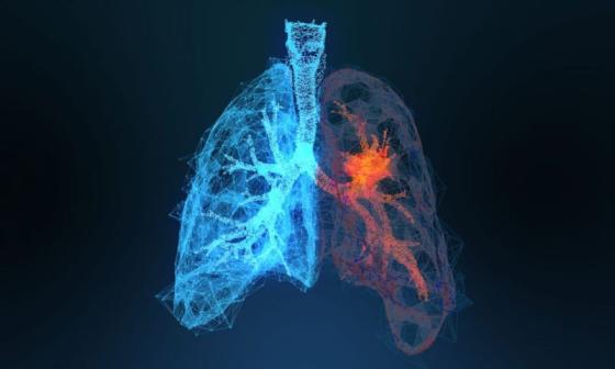 Qureight tech deployed in lung fibrosis clinical trial